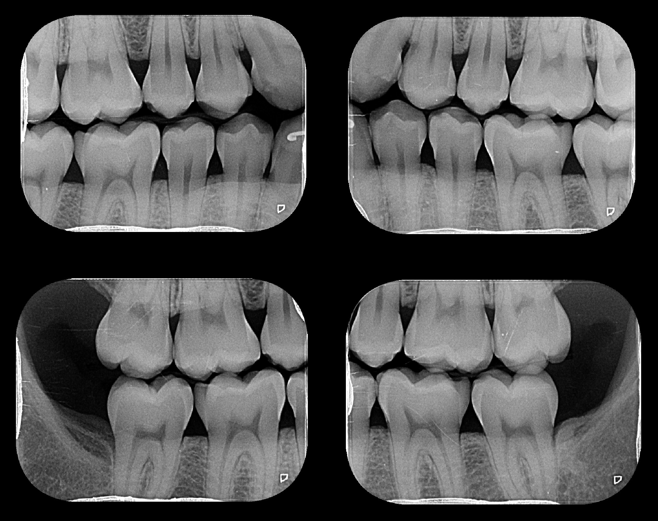Radiografias intraorais realizadas na Aradoc Radiologia Odontológica.